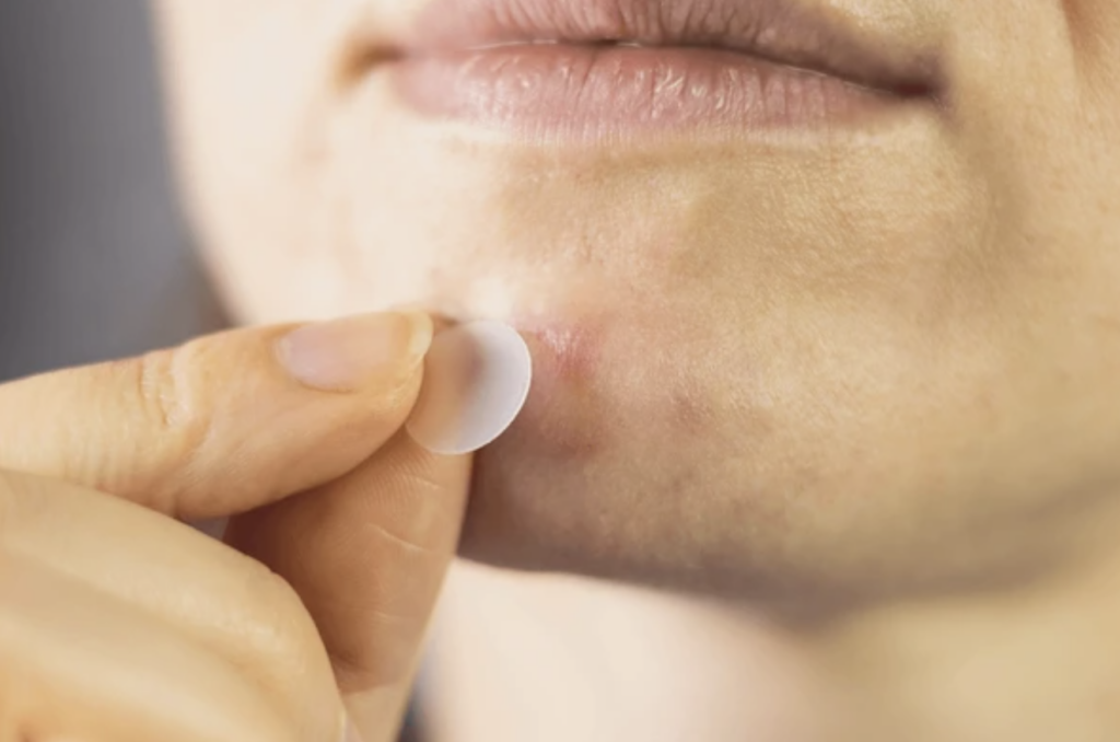 Adult Acne: How to Treat and Prevent Breakouts in Your 20s and 30s
