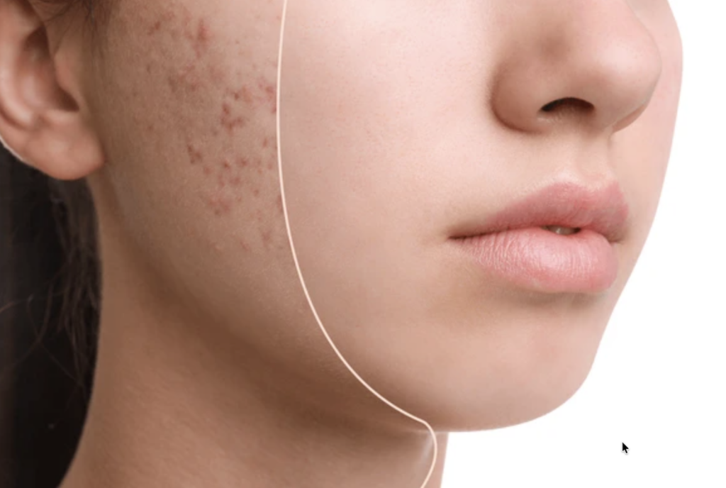 The Best Skincare Routine for Acne-Prone Skin: Tips and Products to Use